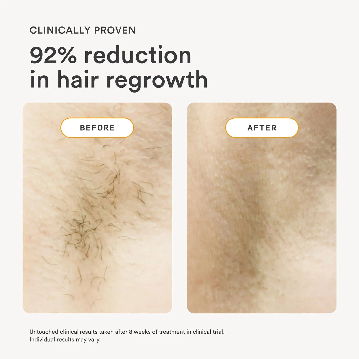 Nood The Flasher IPL Permanent Hair Removal Pain-Free LED Display 2.0